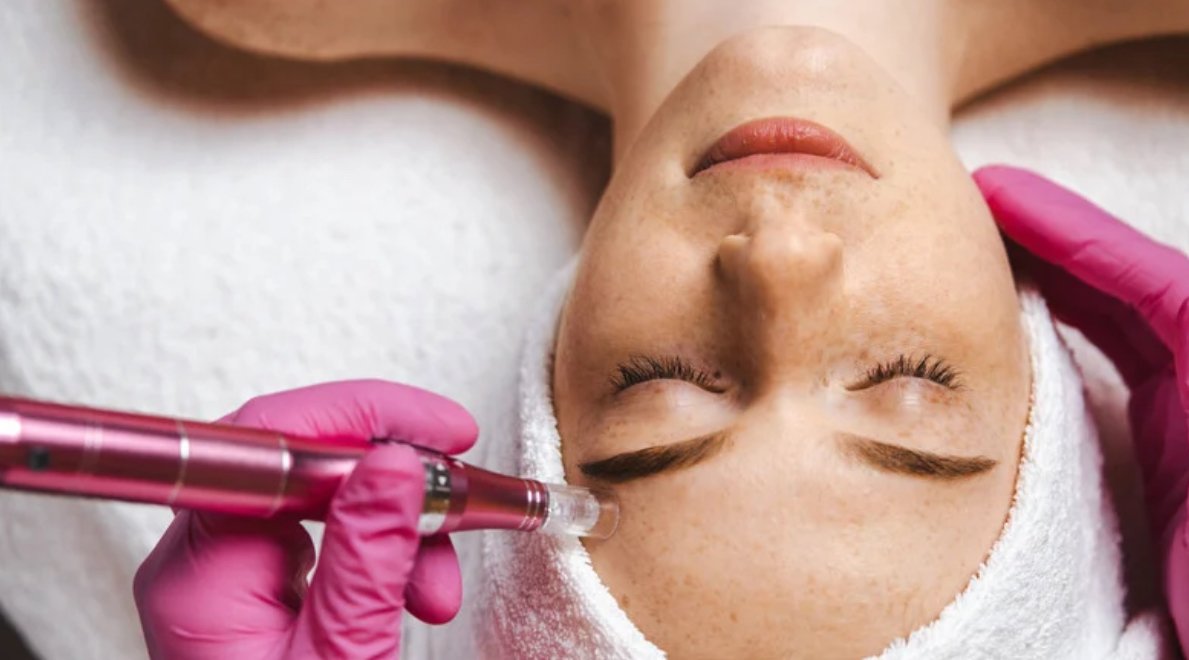 Microneedling