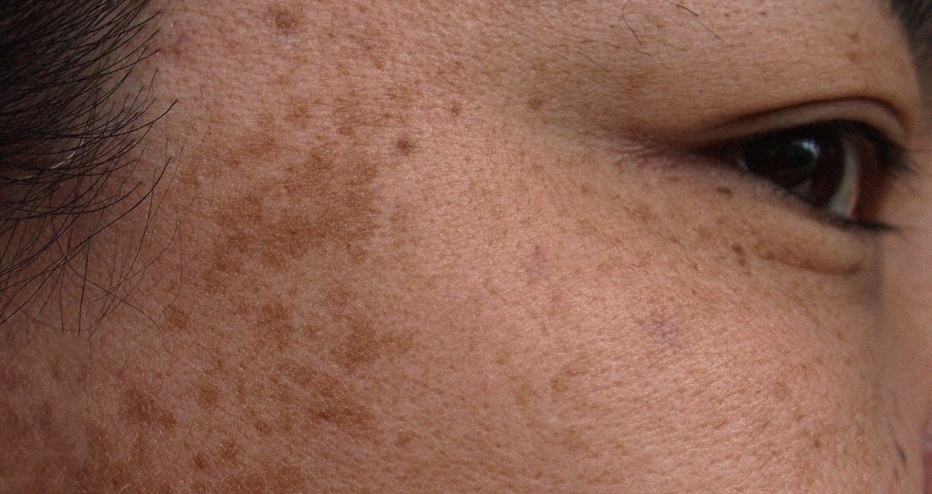 Hyperpigmentation