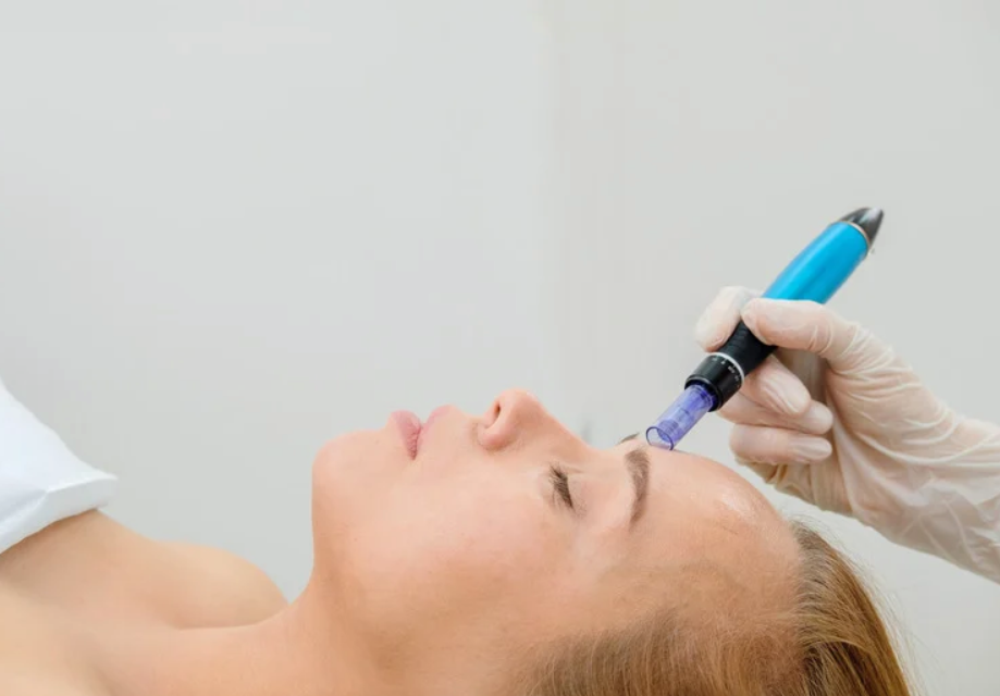 Microneedling