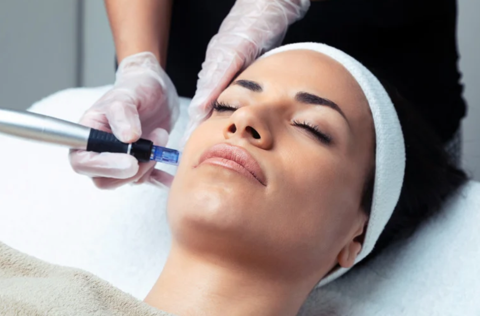 Microneedling