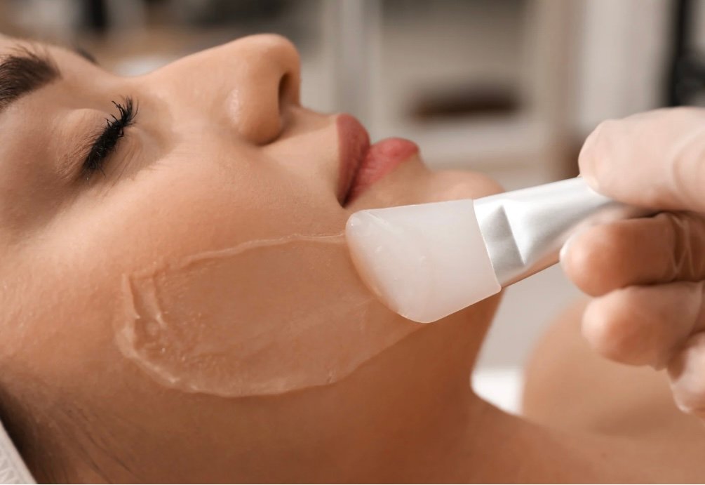 Microneedling and chemical peel
