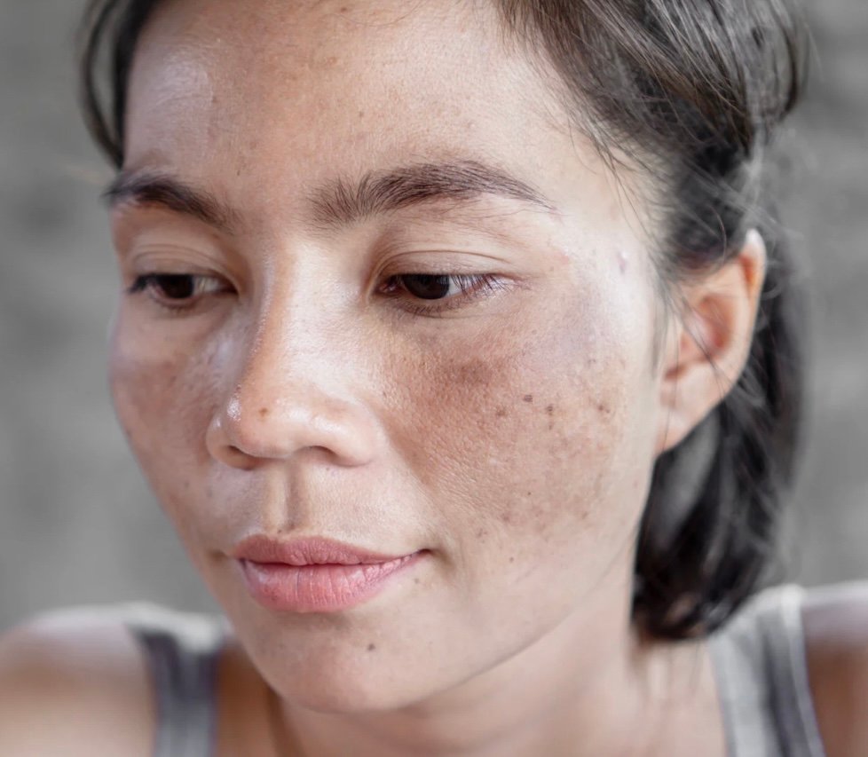 Hyperpigmentation