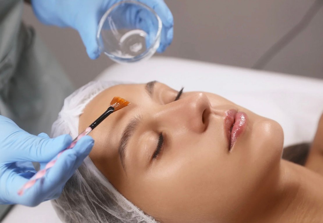 Chemical Peels