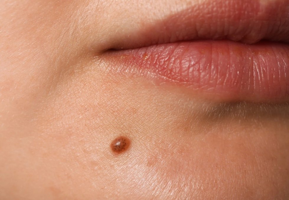 Mole check Manchester Dermatology Clinic