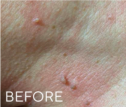 Before treatment result