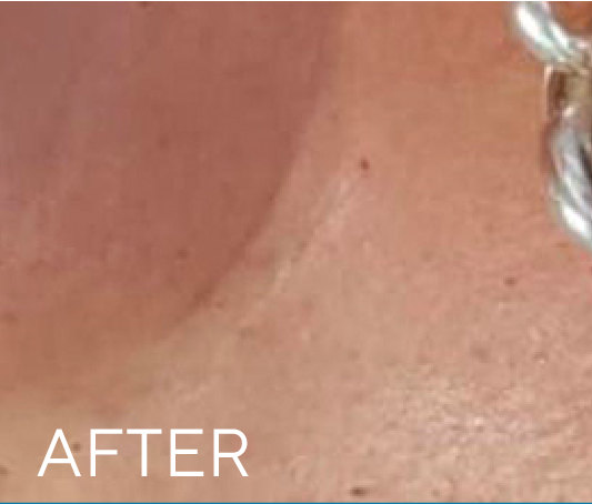 After treatment result
