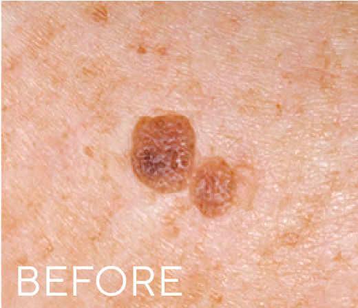 Before treatment result
