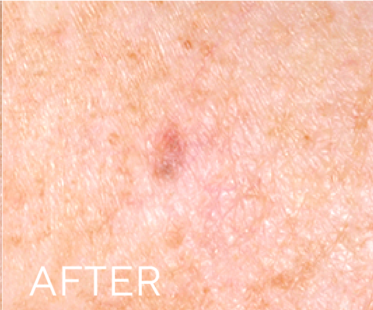 After treatment result