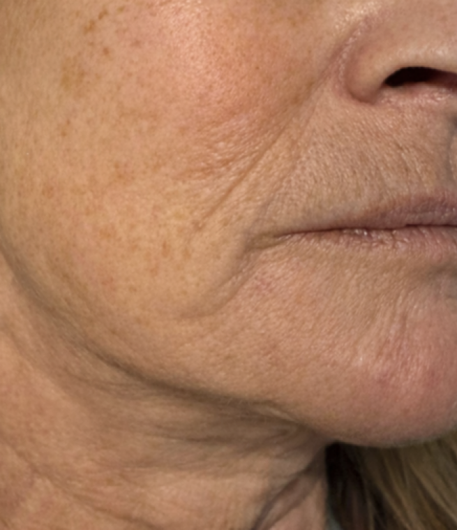 Before treatment result
