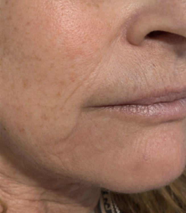 After treatment result