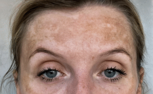 Before treatment result