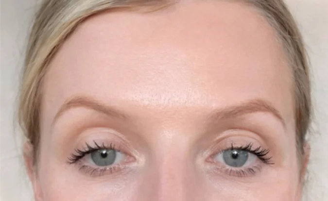 After treatment result