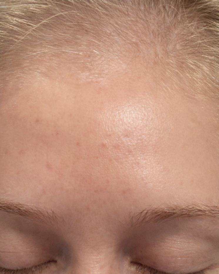 After treatment result