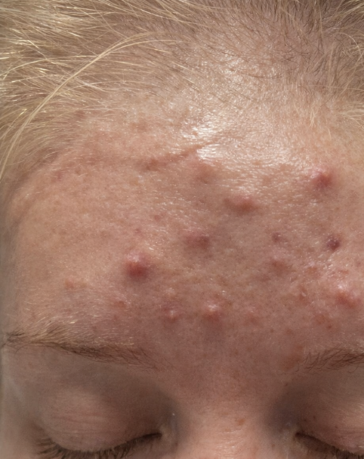 Before treatment result