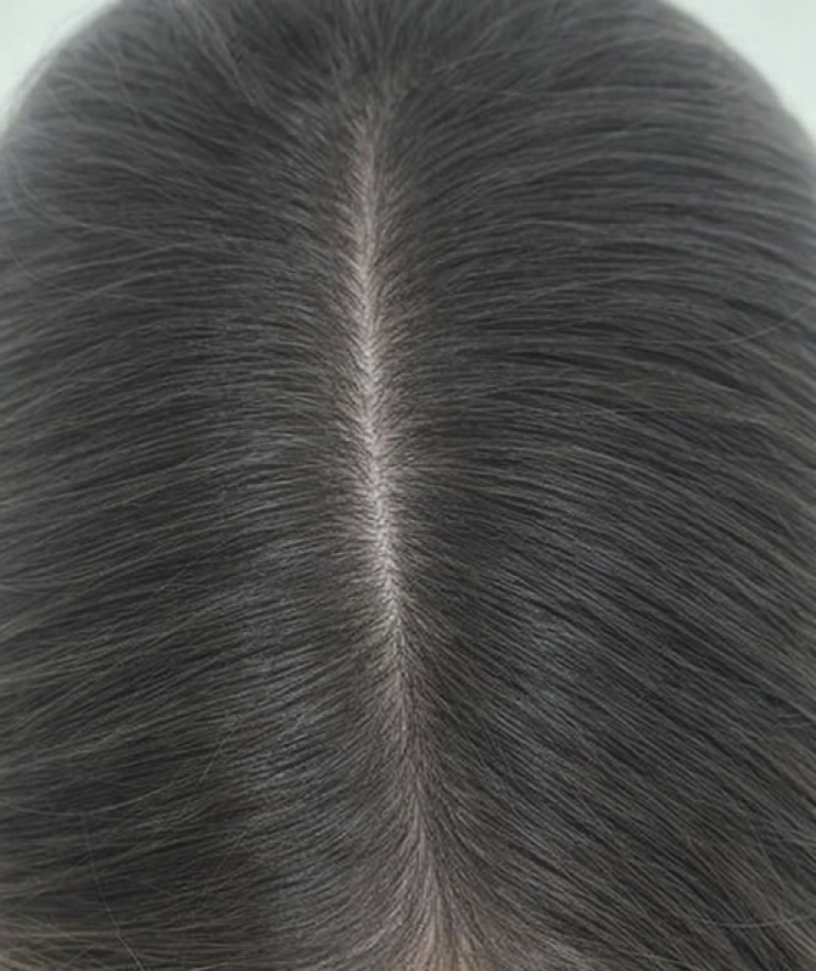 After treatment result