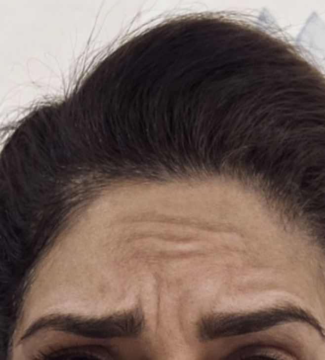 Before treatment result