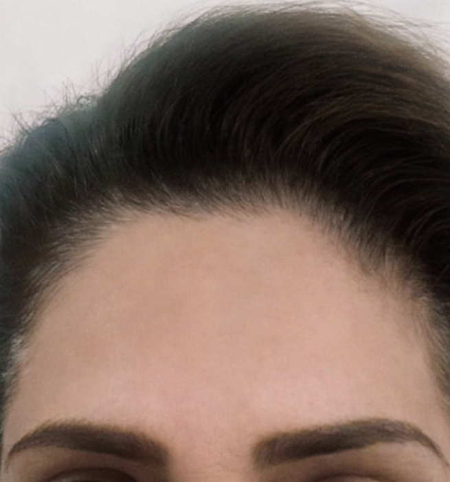 After treatment result