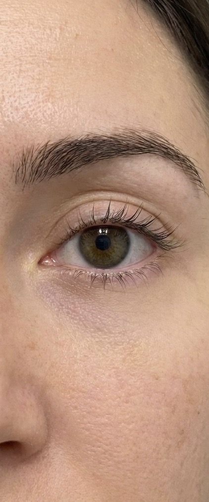 After treatment result
