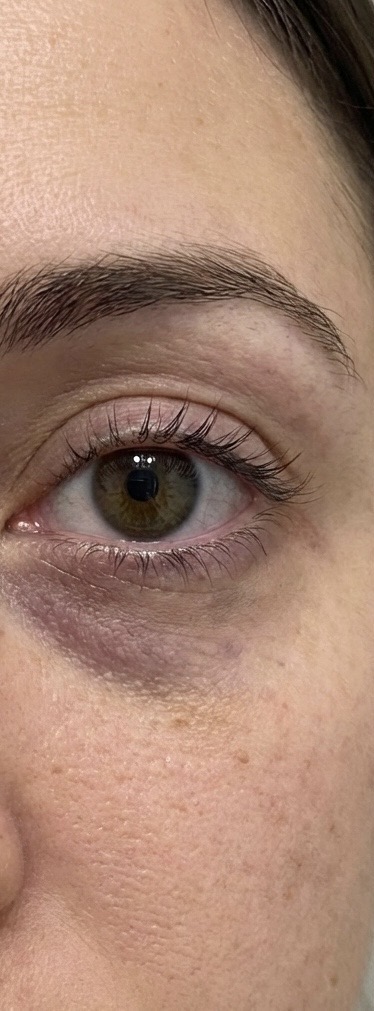 Before treatment result