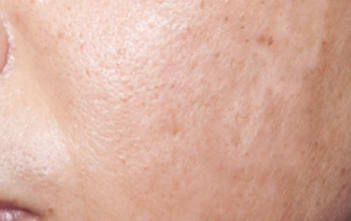 After treatment result