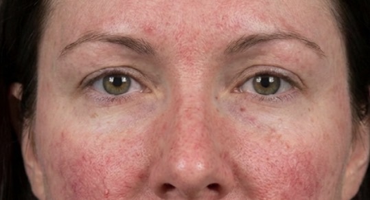 Before treatment result