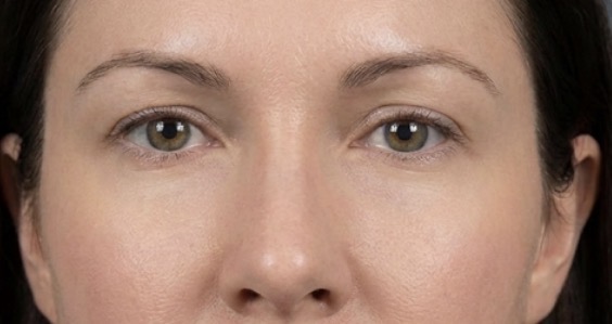 After treatment result