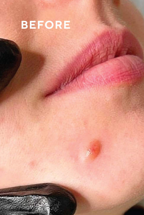 Before treatment result
