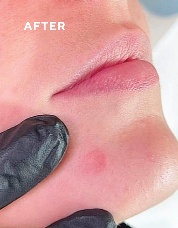 After treatment result