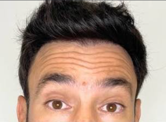 Before treatment result