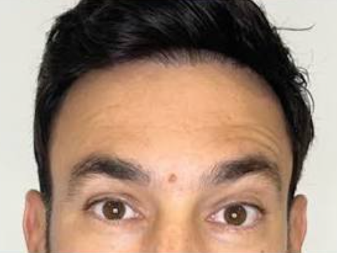 After treatment result