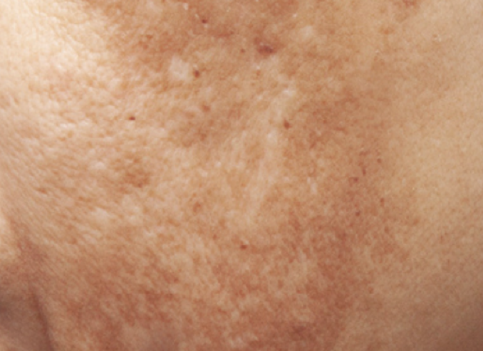 Before treatment result